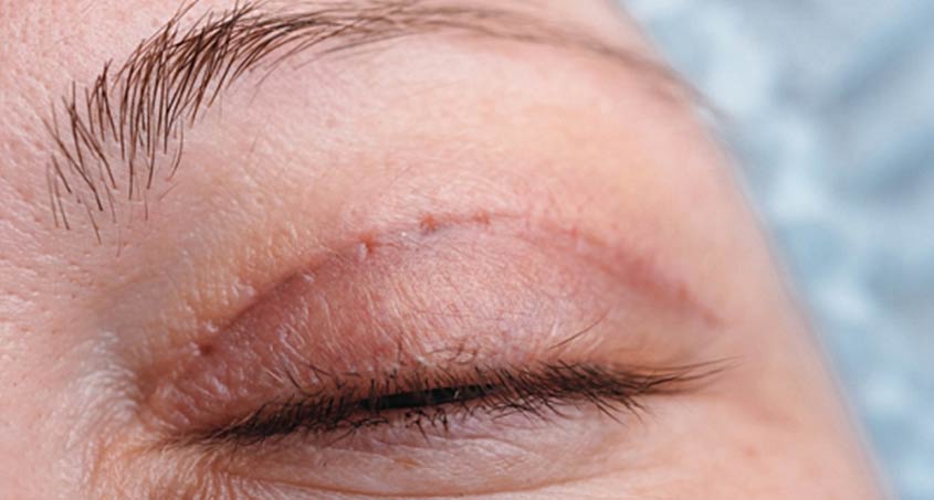 Blepharoplasty