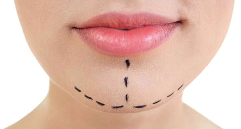 Chin Augmentation (Genioplasty)