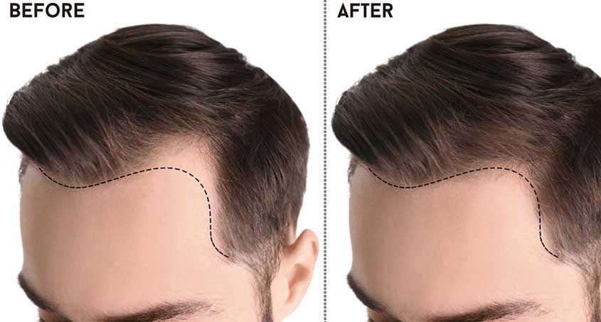 Hair Transplant 