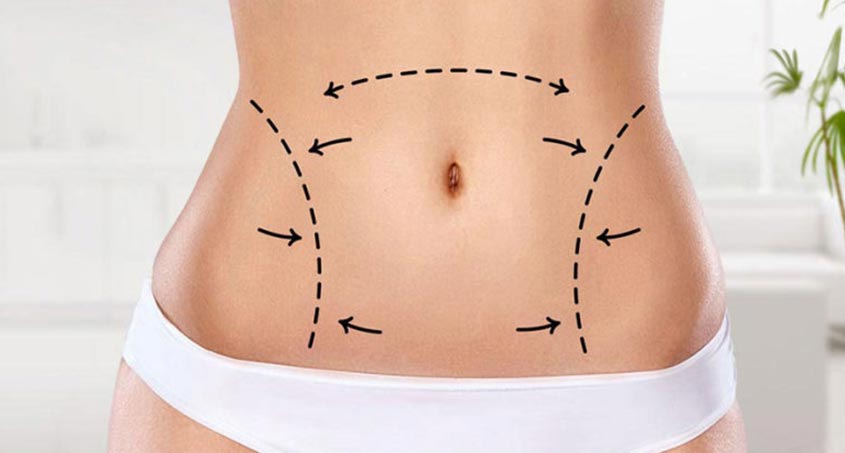 Liposuction 